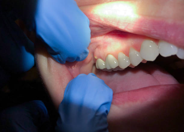 Best Emergency Wisdom Tooth Extraction in Forest Lake, MN